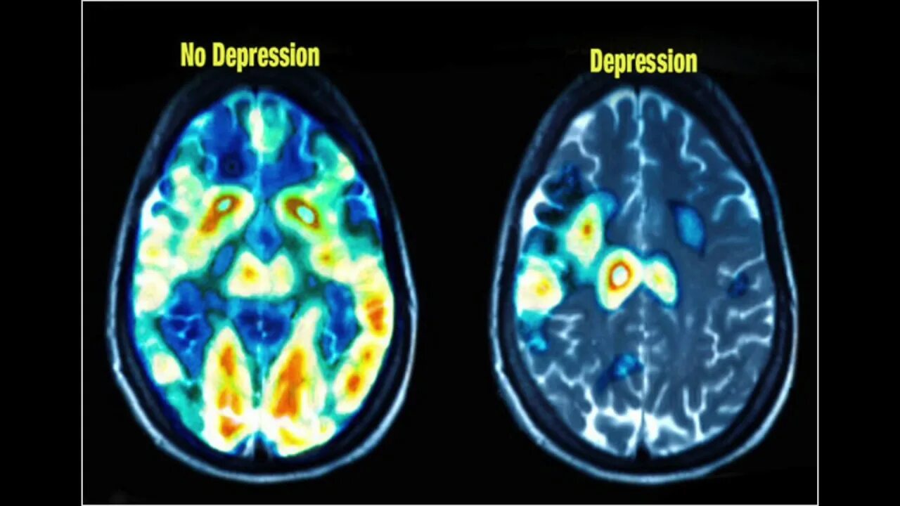 Мозг при депрессии. Мозг человека с депрессией. Мозг при депрессии на томографе. Мрт мозга при депрессии.