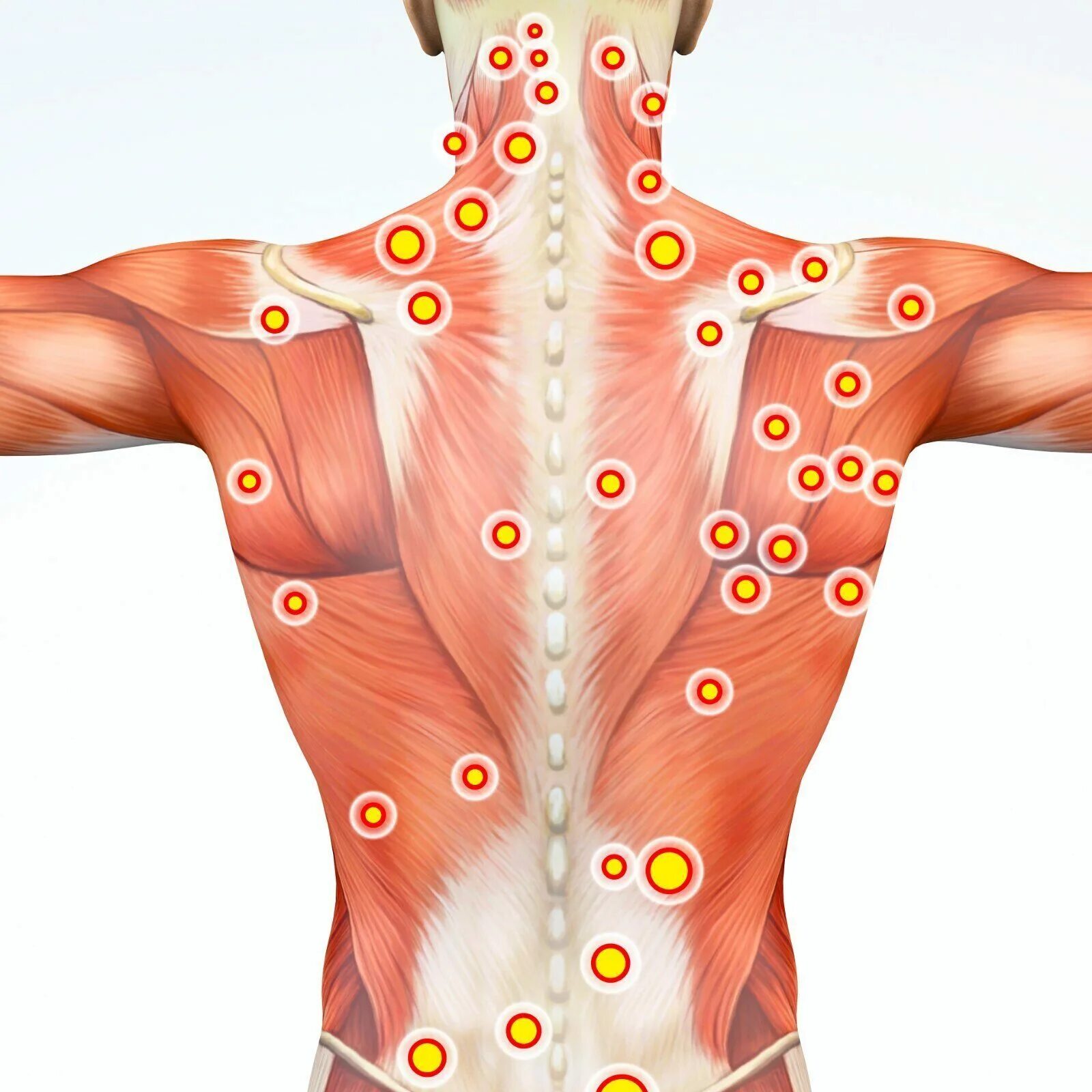 Миофасциальный массаж тела это. Триггерные точки в мышцах спины. Миофасциальный синдром триггерные точки спины. Триггерная точка миофасциальный болевой. Миофасциальный болевой синдром триггерные точки.