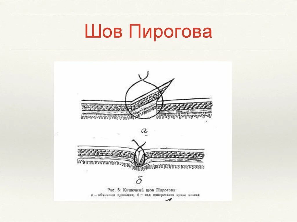 Стерильный шов. Кишечные швы шов Пирогова. Шов Пирогова Матешука. Шов Пирогова черни кишечных швов. Однорядный шов Пирогова.