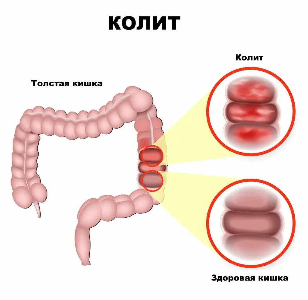 Колит кишечника симптомы и лечение. Язвенный колит толстого кишечника. язвенный проктосигмоидит. язвенная колети кшичники. язвенный колит проктосигмоидит.