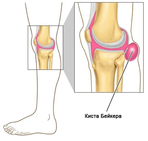 Кисть в колене. Кисть в колене. Гигрома лучезапястного сустава мкб 10. Кисть в колене. Киста бейкера коленного сустава.