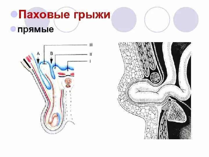 Прямая паховая грыжа схема. Косая паховая грыжа слои. Косые паховые грыжи схема. Косые и прямые паховые грыжи схема. Прямая и косая паховые грыжи