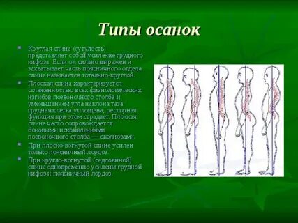 Усиленный кифоз