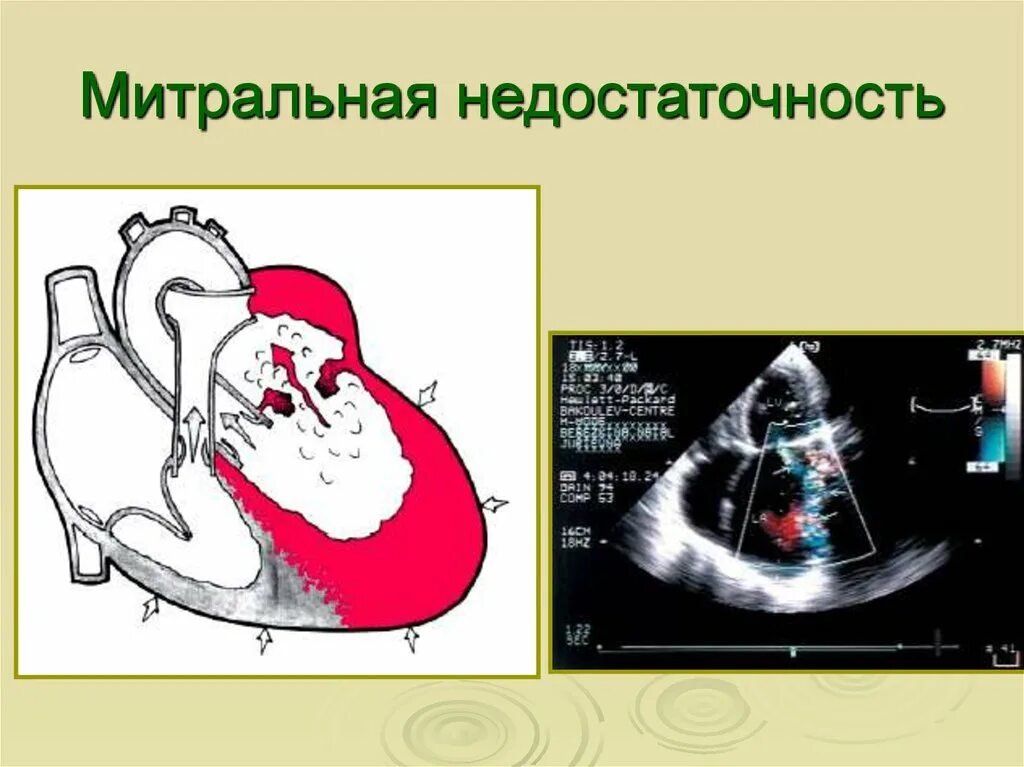 Недостаточность митрального клапана сердца. Приобретенные пороки сердца схема гемодинамики. Врожденный порок сердца пролапс митрального клапана. Недостаточность двустворчатого (митрального) клапана. Недостаточность митрального клапана степени тяжести.