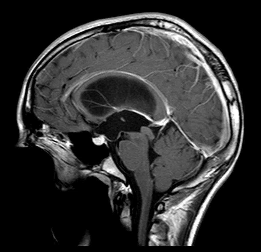 Глиома ствола мозга мрт. Диффузная глиома ствола головного мозга.