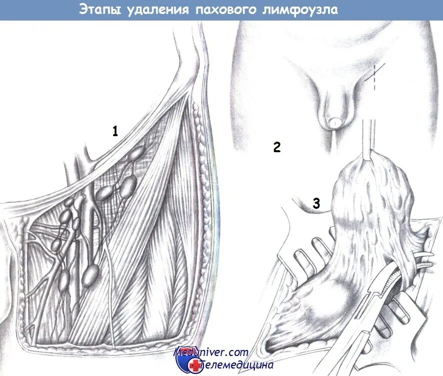 Пахово бедренные лимфоузлы. Паховая лимфаденэктомия (операция Дюкена). Воспаление лимфатических узлов в паху. Воспаление пахового узла. Тазовая лимфаденопатия