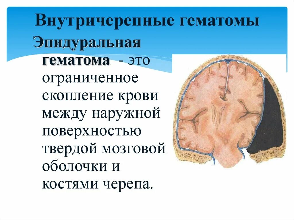 Внутричерепное давление головного мозга. Черепно-мозговая травма презентация. Скопление крови в полости черепа.