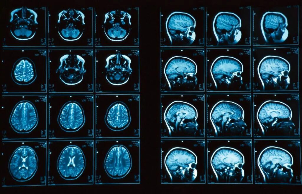 Кт томограмма головного мозга. Магнитно-резонансная томография мрт снимки. Компьютерная томография кт головного мозга. Магнито-резонансная томография головного мозга.