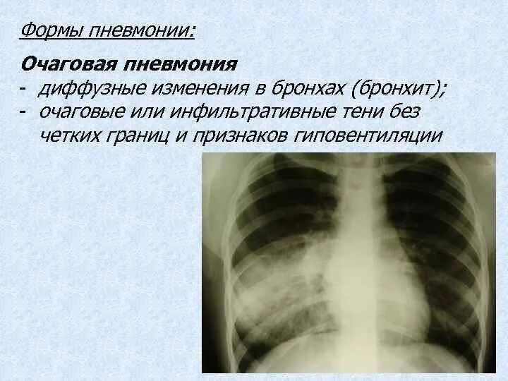 Что означает изменения в легких. Очагово сливная пневмония рентген. Симптомы пневмонии очагово сливная. Верхнедолевая очаговая пневмония. Очаговая пневмония симптомы.