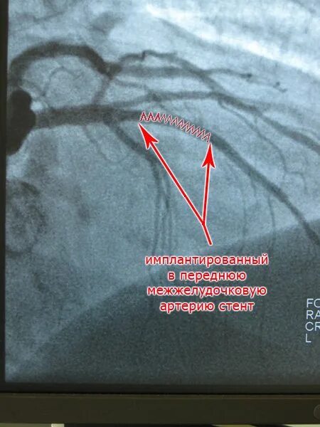 Стентирование коронарных артерий схема. Передней межжелудочковой артерии. Осложнения после стентирования коронарных сосудов. Осложнения после стентирования сосудов сердца. Осложнения после стентирования коронарных сосудов сердца.