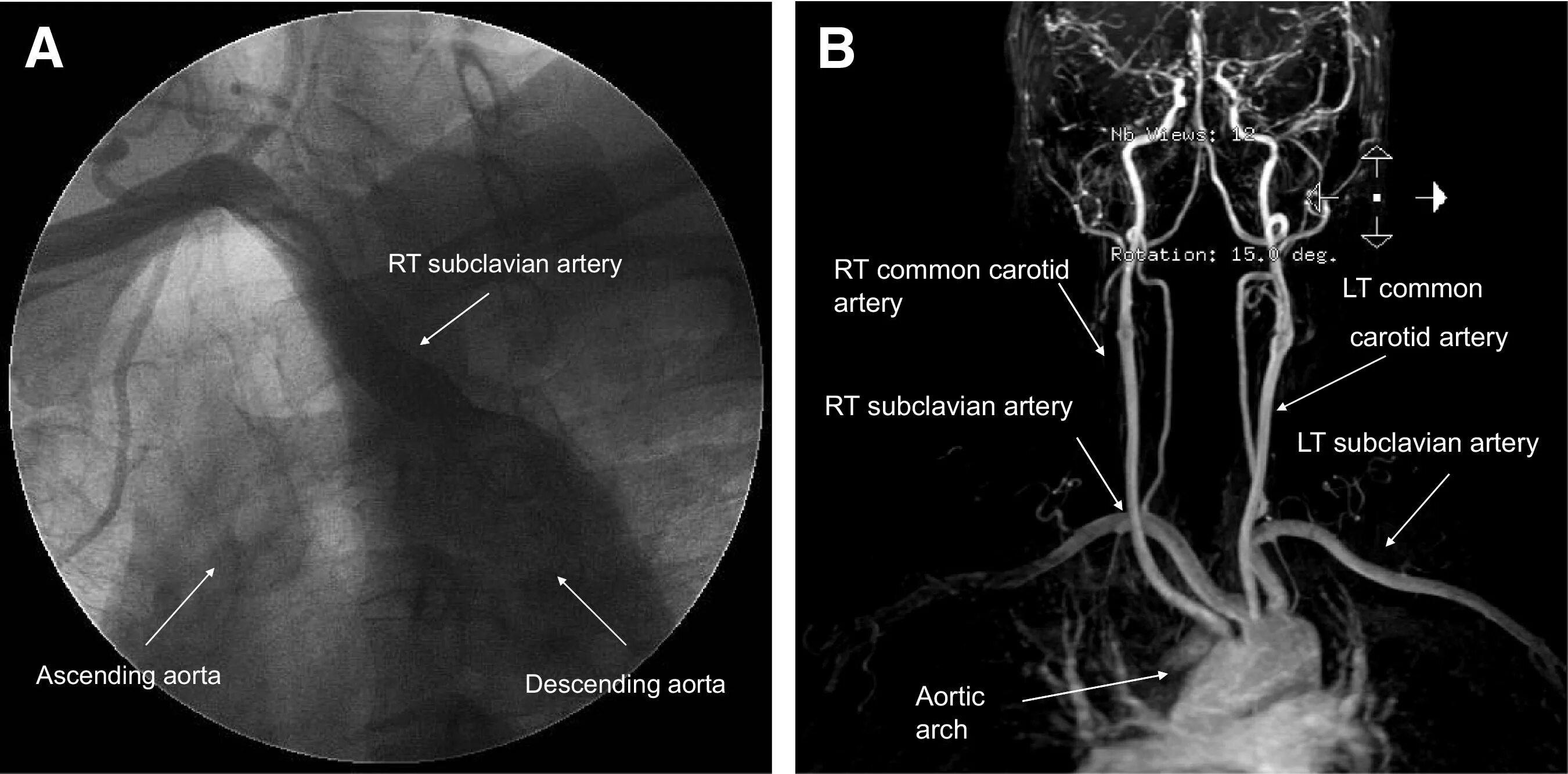 Артерия lusoria. Аберрантная правая подключичная артерия (a. lusoria). Артерия люзория рентген.