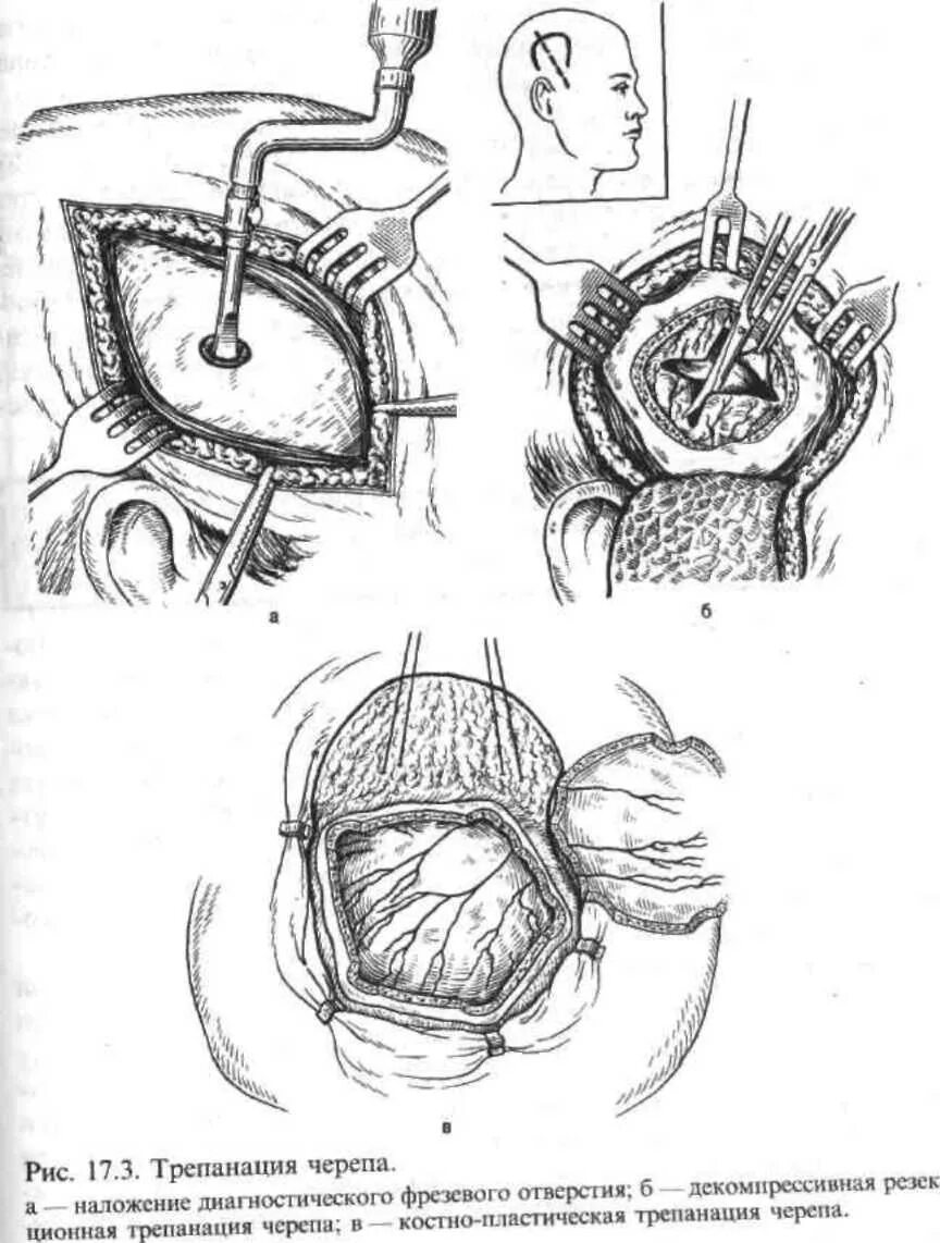 Костно-пластическая Трепанация черепа ход операции. Резекционная Трепанация черепа. Костноплачтияеская Трепанация черепа. Костно пластическая и декомпрессионная Трепанация черепа.