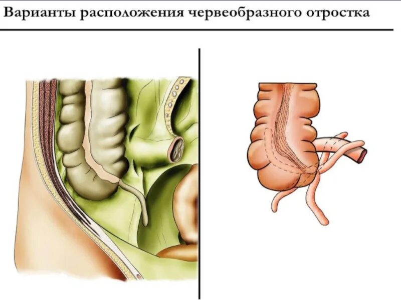 Локализация острого аппендицита. Топография червеобразного отростка. Расположение червеобразного отростка. Ретроперитонеальное расположение червеобразного отростка.