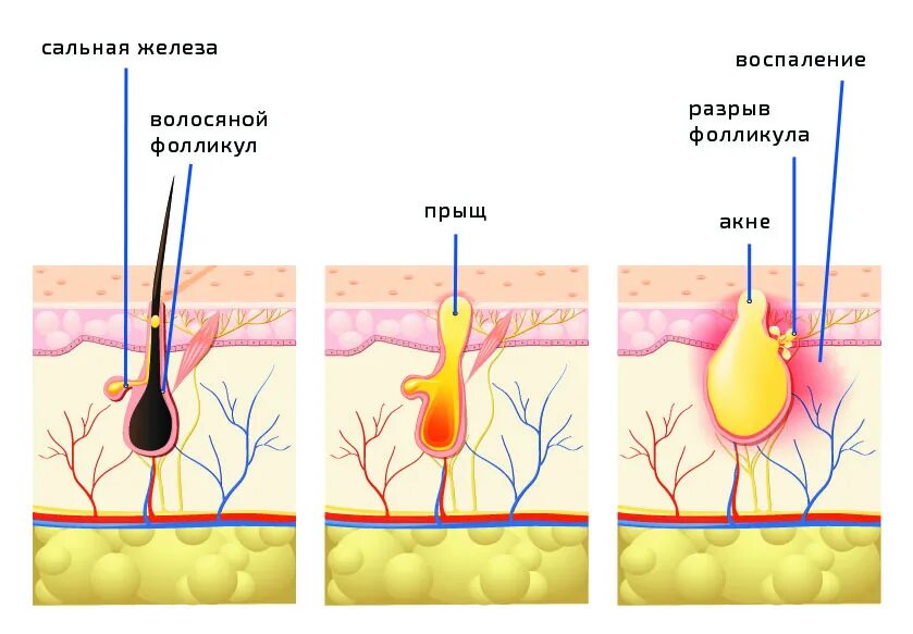 Фолликулит воспаление сальной железы. Фолликулит волосяного фолликула. Воспаление сальной железы и волосяного фолликула. Фолликулит – воспаление волосяных фолликул..