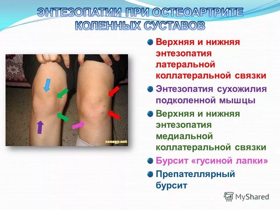 Энтезопатия сухожилий тазобедренного сустава. Энтезопатия гусиной лапки. Энтезопатии коленного сустава. Энтезит коленного сустава.