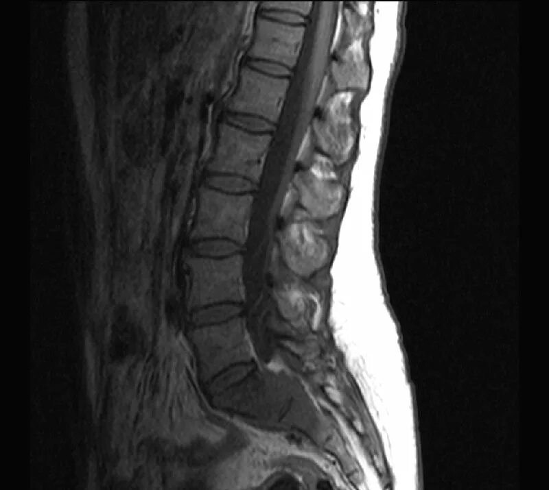 Мрт пояснично крестцового отдела позвоночника цена москва. Метастазы в поясничном отделе позвоночника мрт. Гемангиома позвоночника мрт. Метастазы грудного отдела позвоночника на мрт. Метастазы в позвоночнике на мрт.