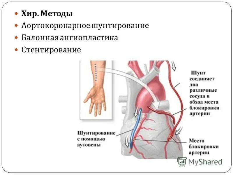 Установка шунта. Коронарное шунтирование сосудов сердца. Шунтирование артерии операция. Артерио коронарное шунтирование. Аортокоронарное шунтирование осложнения.