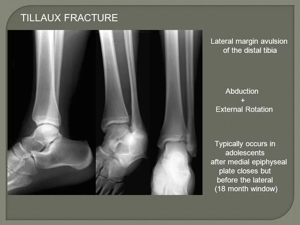 перелом мальгеня рентген лодыжка. перелом латеральной лодыжки. перелом лодыжки мкб s82. остеосинтез медиальной лодыжки.
