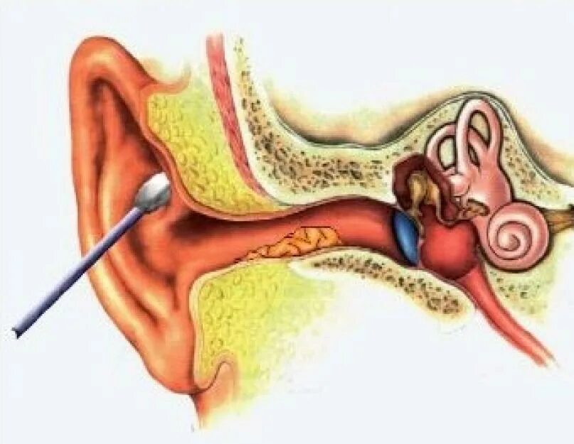Почему серные пробки в ушах. Прокол барабанной перепонки отит. Отомикоз слухового прохода. Отомикоз серная пробка.