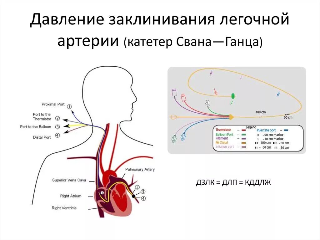 Катетер Сван Ганса измерение давления. Катетеризация легочной артерии катетером Сван-Ганса. Давление в легочных капиллярах в норме. Давление заклинивания легочных капилляров.