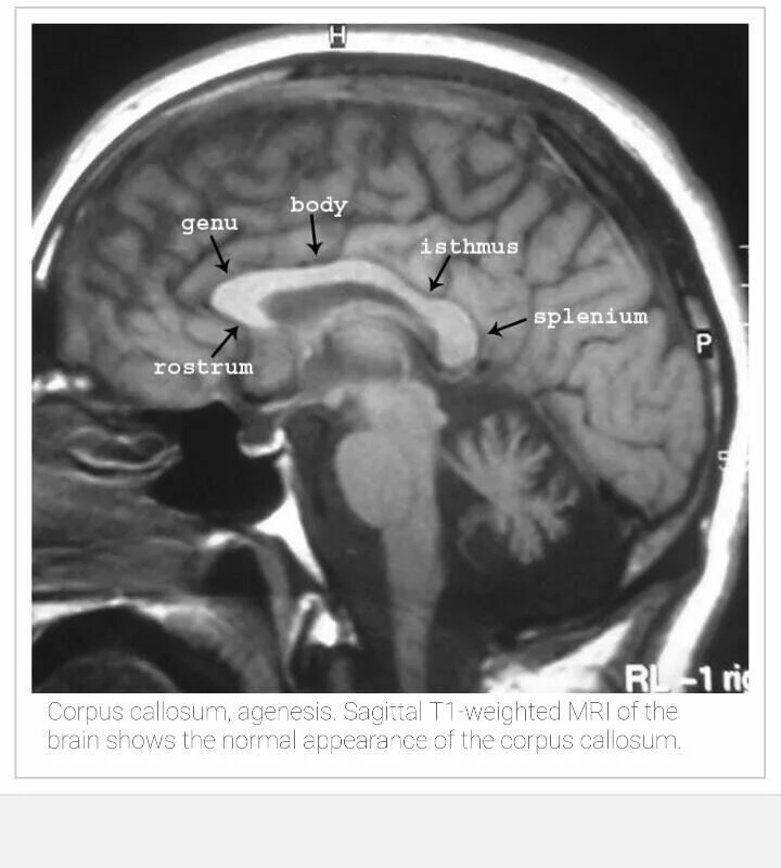 Гипоплазия червя. Мозолистое тело на кт анатомия. Агенезия мозолистого тела на кт. Гипоплазия мозолистого тела кт. Мозолистое тело гипоплазия на НСГ.
