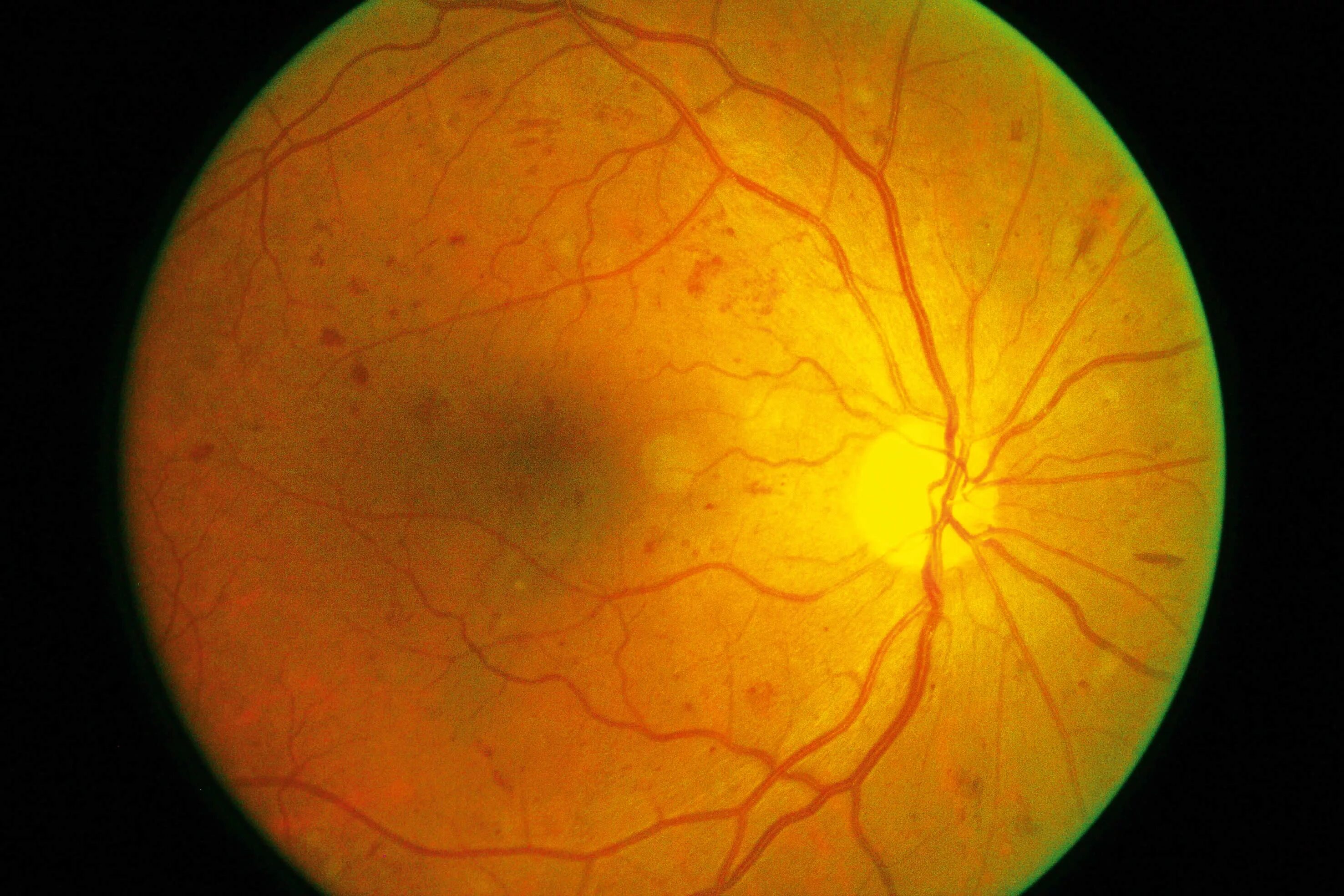Непролиферативная диабетическая ретинопатия. Атеросклеротическая ретинопатия. Диабетическая ретинопатия сетчатки. Диабетическая ретинопатия глаз.