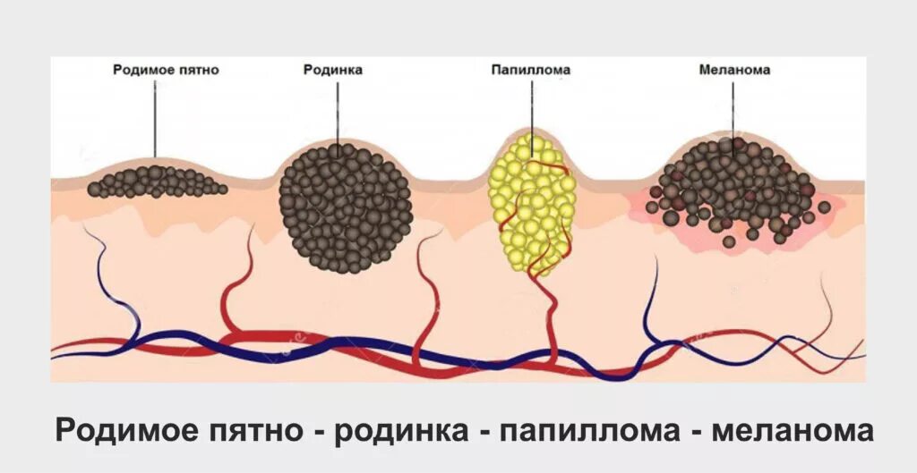 Распад кожи