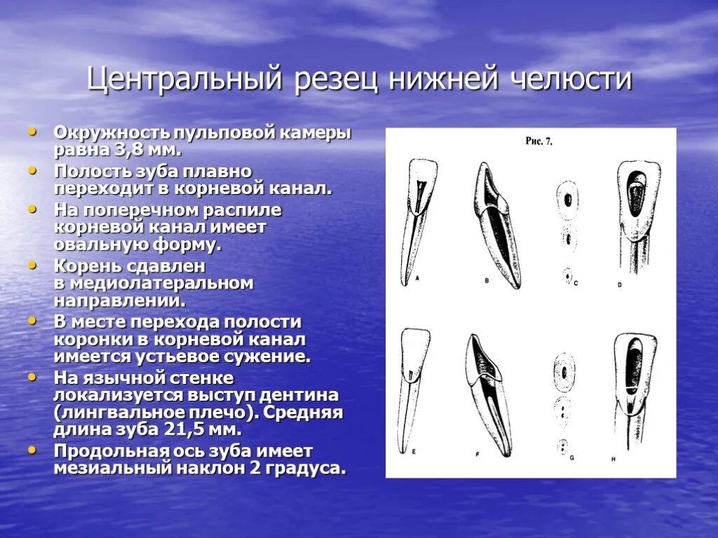 Зуб боковой резец. Боковой резец нижней челюсти эндодонтия. Центральный резец нижней челюсти полость зуба. Эндодонтия бокового резца верхней челюсти. Пульповая камера резца.