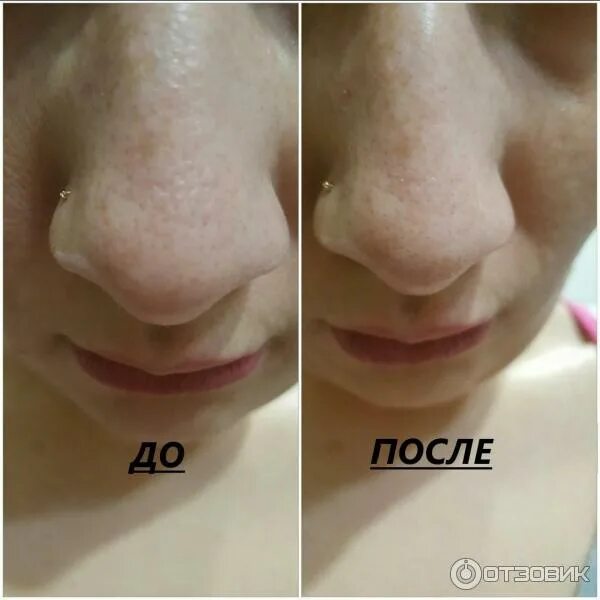 Альгинатная маска до и после. Альгинатные маски до после. Альгинатная маска до и после фото. До и после альгинатной маски.
