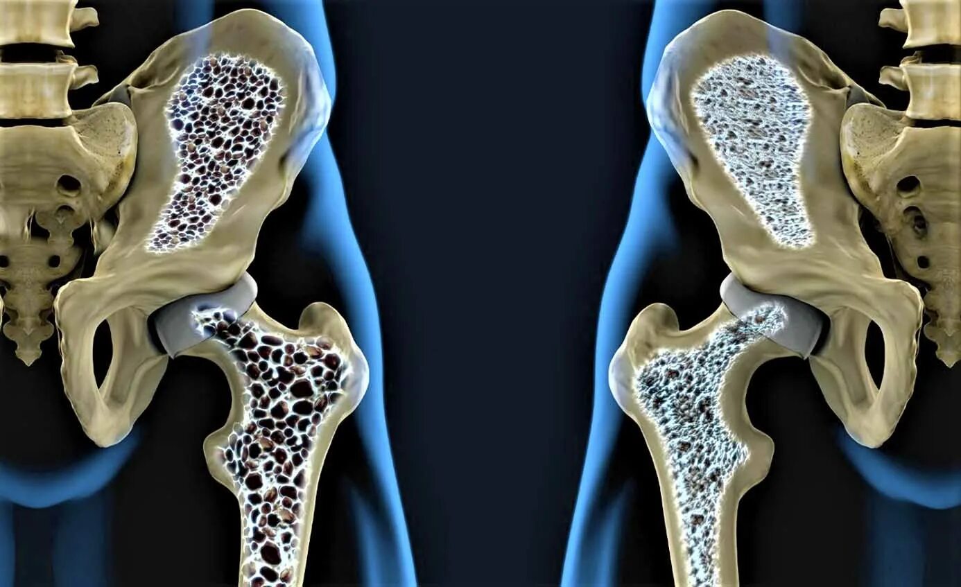 Остеопороз кости. Остеопороз тазовой кости. Транзиторный остеопороз кт. В костях и т д