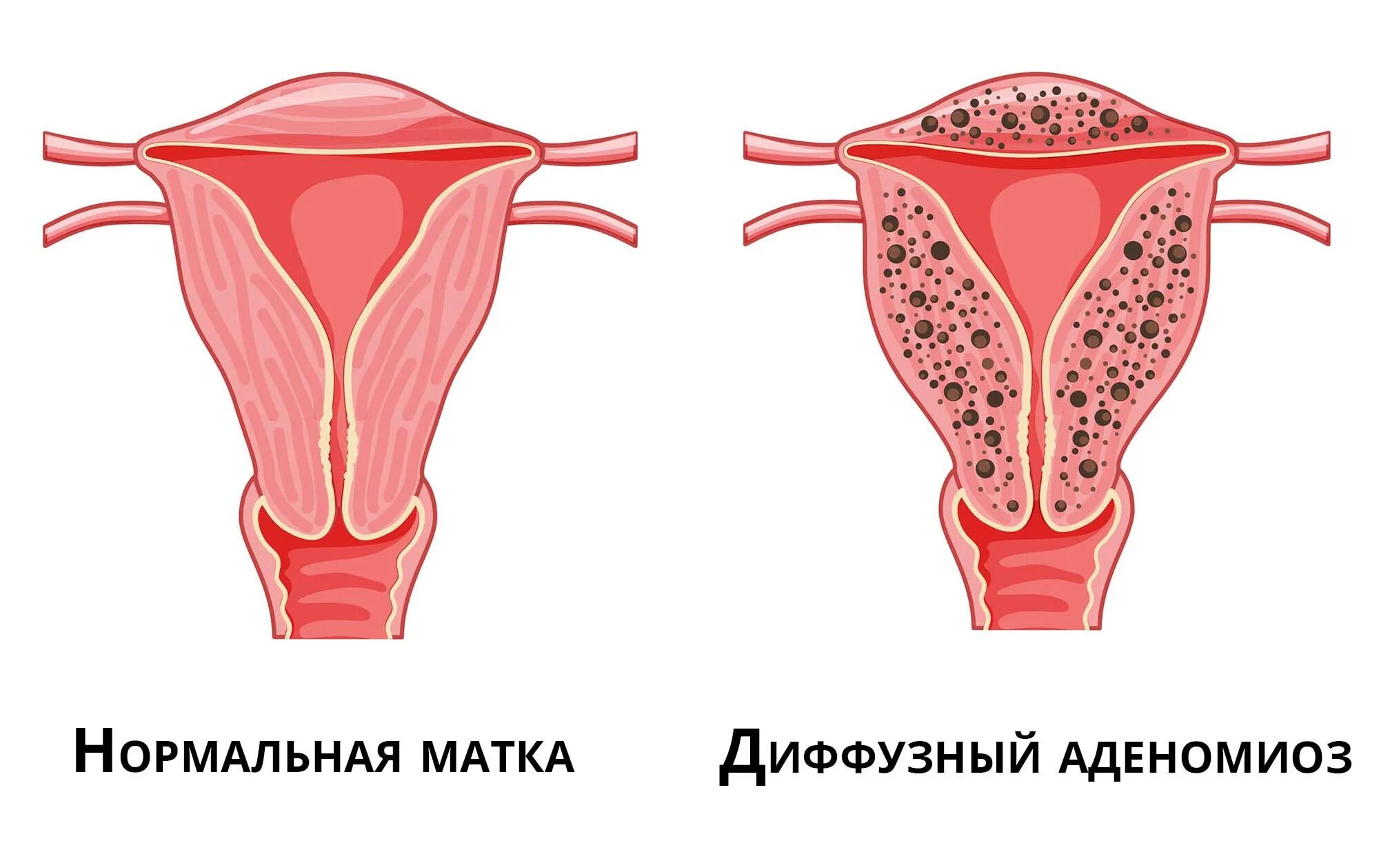 Диффузная матка. Диффузная матка