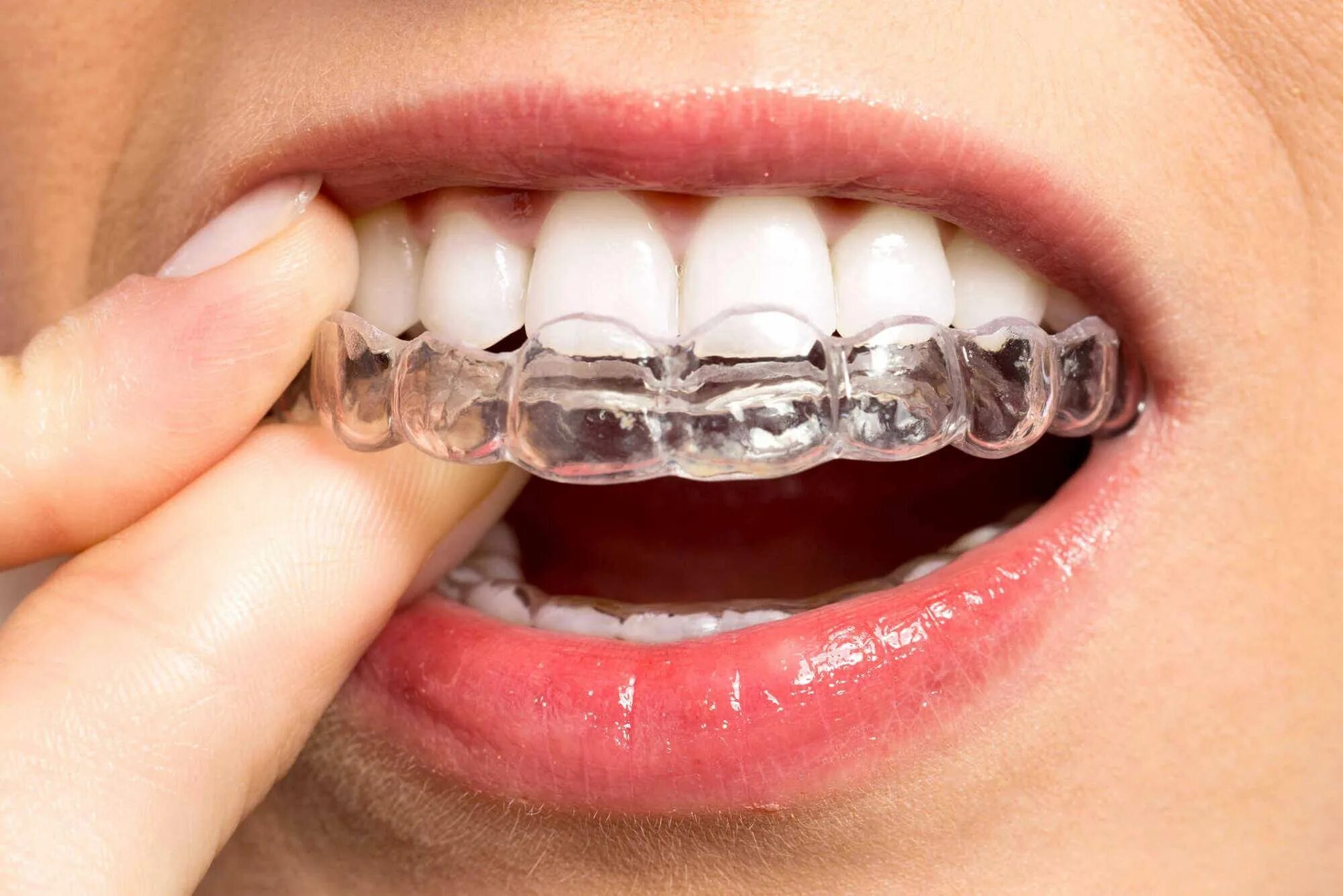 1Pcs Soft Orthodontic Braces Teeth Retainers Boxing Tooth Protector Dental Mouth