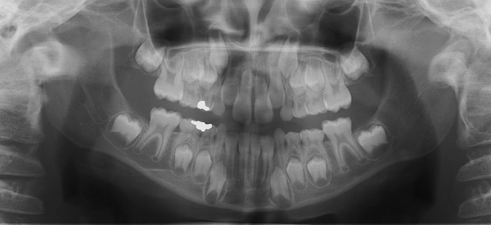 Снимок зубов видное. Зачатки коренных зубов рентген. Снимок молочных зубов рентгеновский.