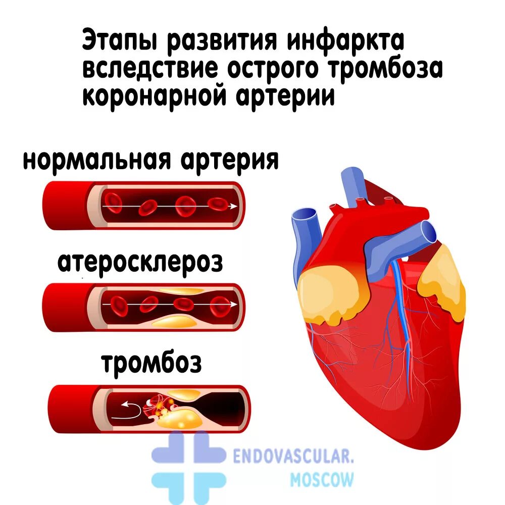 Инфаркт причины симптомы. Симптомы ИБС инфаркт миокарда. Причины развития острого инфаркта миокарда. Коронарные артерии инфаркт. Бляшки инфаркт миокарда.