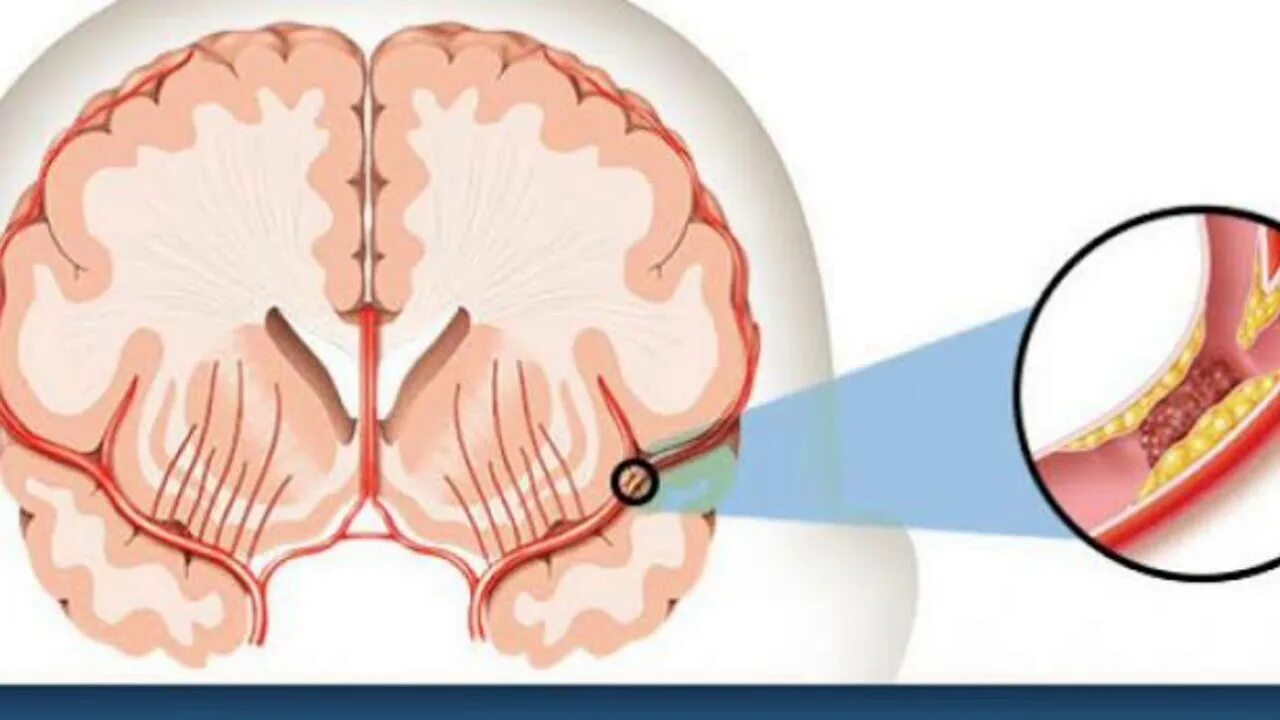 Атеротромботический инсульт. Атеротромботический ишемический инсульт. Ишемический инсульт атеротромботический вариант. Тромбоз мозговых артерий. Тромбоз мозговых сосудов