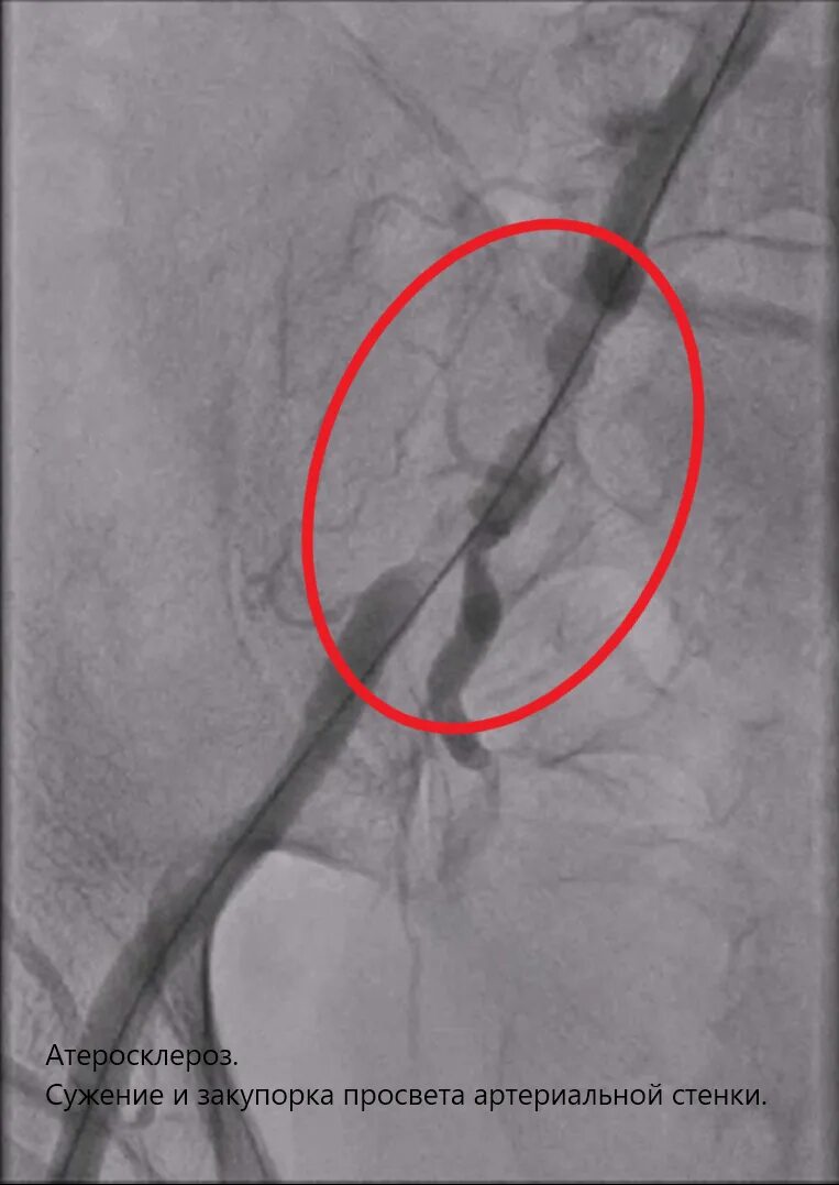 После стентирование самолет. Стентирование сосудов нижних конечностей. Стентирование бедренной артерии. Стентирование огибающей артерии.