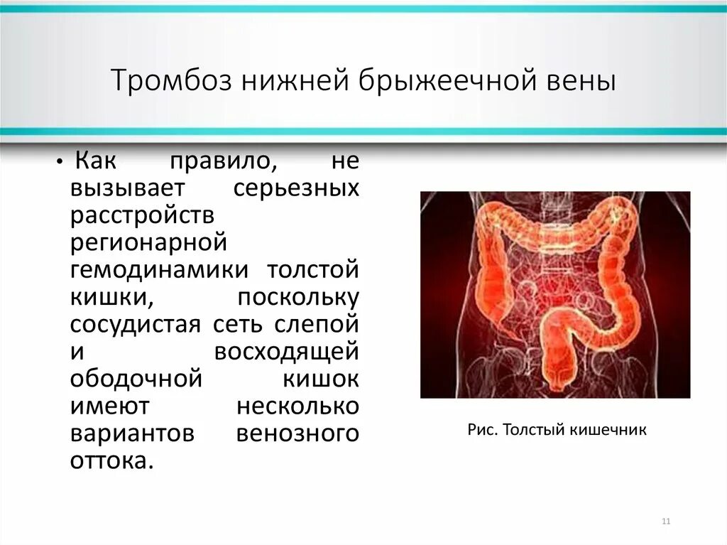 Тромбоз брыжеечных сосудов. Венозный мезентериальный тромбоз. Тромбоз брыжеечной вены. Тромбоз нижней брыжеечной вены. Мезентериальный тромбоз код