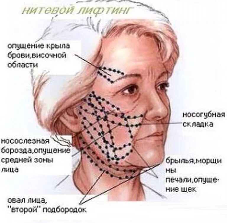 Схема подтяжки лица. Нити Аптос для подтяжки лица схема. Схема введения нитей Аптос. Подтяжка лица нитями схема.