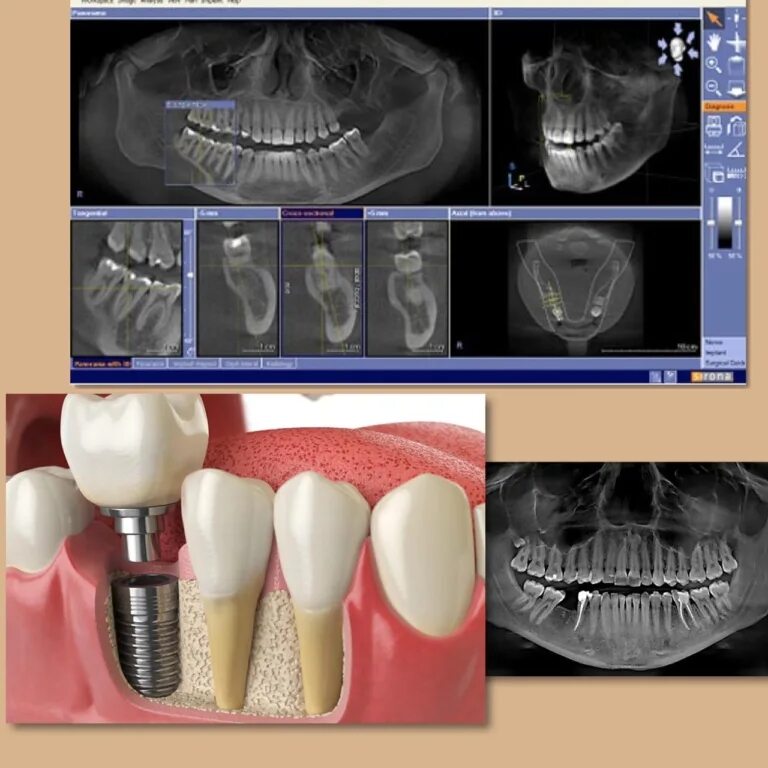 Зубные имплантаты стелс. Стоматологические импланты. Зубы импланты поэтапно