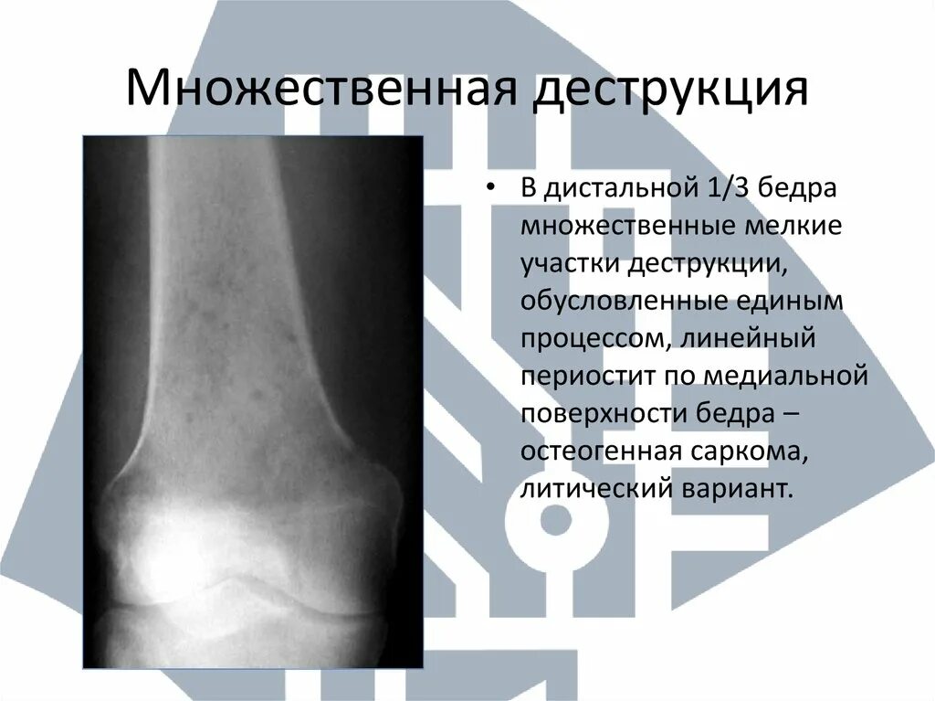 Диструкция или деструкция что это. Диструкция или деструкция что это. Очаг деструкции костной ткани рентген. Диструкция или деструкция что это. Деструкция полимеров.