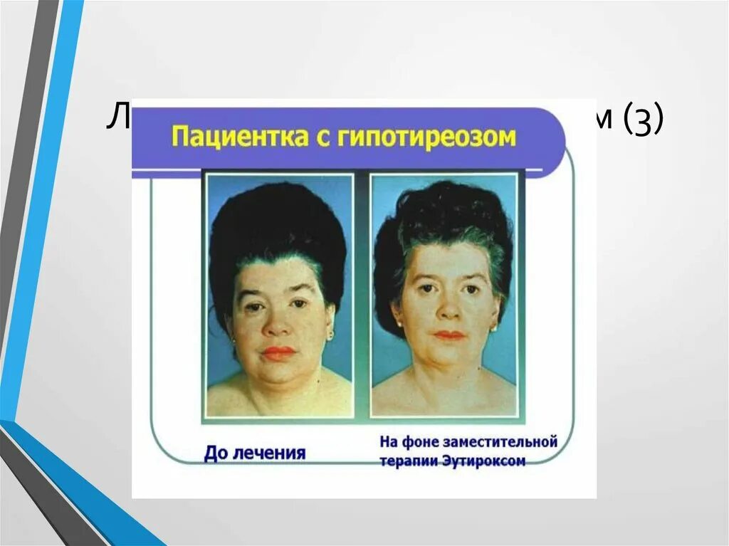 Тканевой гипотиреоз. Клинические проявления гипофункции щитовидной железы. Что такое гипотиреоз щитовидной железы у женщин. Щитовидная железа при гипотиреозе. Недостаток гармоно в щитовидной железы.