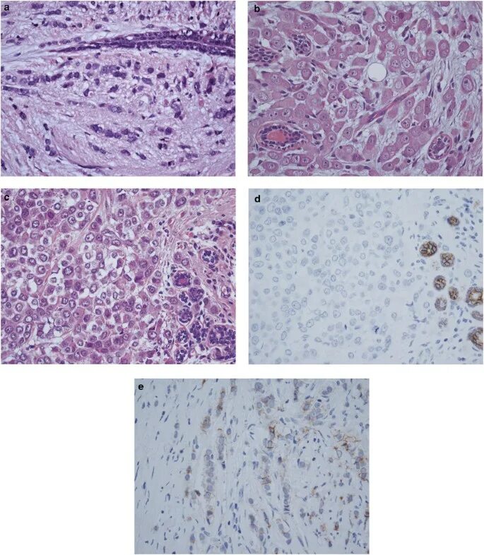Эндометриальная стромальная саркома. Плеоморфная аденома гистология. Плеоморфная карцинома. Инвазивная лобулярная карцинома. Плеоморфная аденома патанатомия.