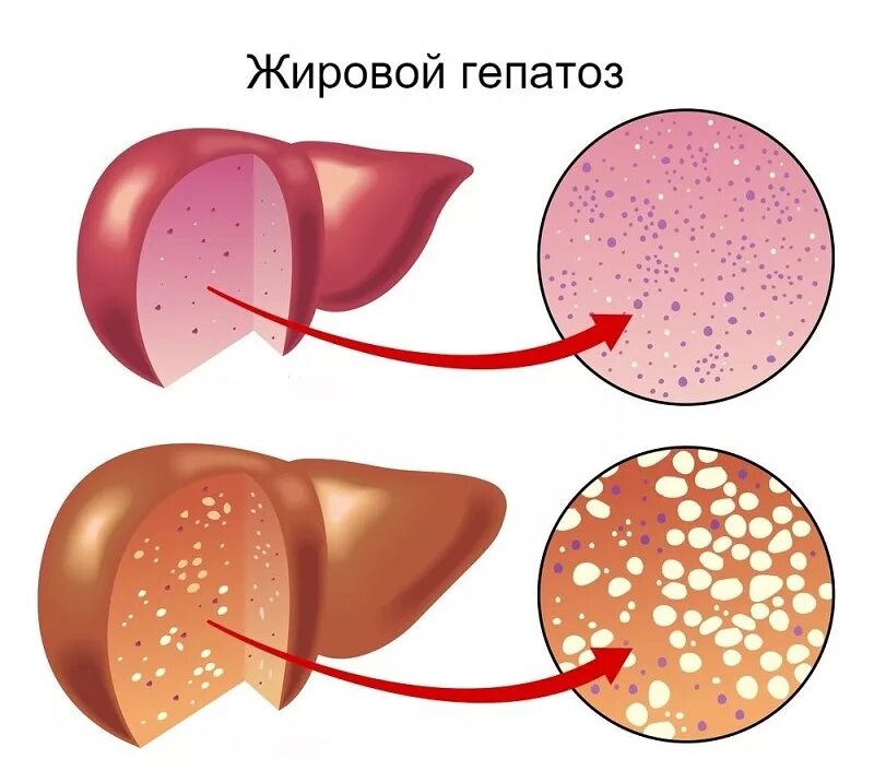 Как вылечить стеатоз