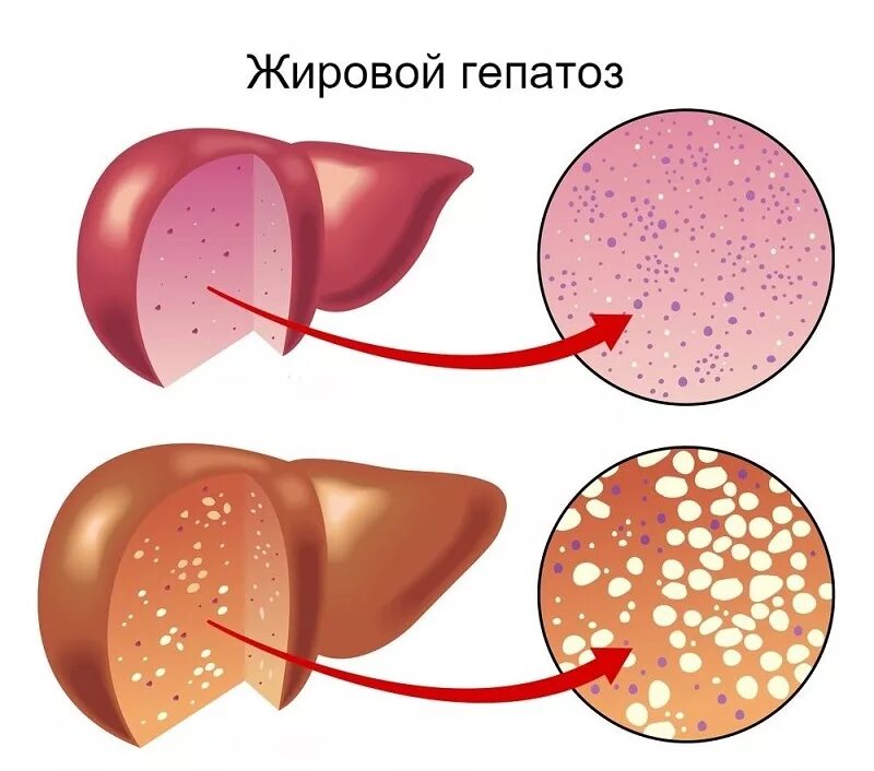 Гепатоз печени что это симптомы. Жировой гепатоз (стеатоз) печени. Жировая дистрофия печени гепатоз. Неалкогольный жировой гепатоз.