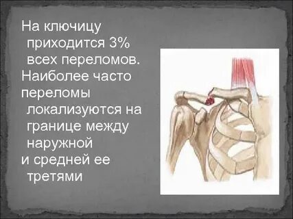 Перелом грудины без смещения