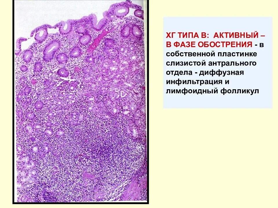Лимфоидная инфильтрация что это. Лимфоидный фолликул в кишечнике гистология. Лимфофолликулярная гиперплазия антрального отдела желудка. Лимфофолликулярная гиперплазия слизистой оболочки желудка что это. Лимфофолликулярная гиперплазия гистология.