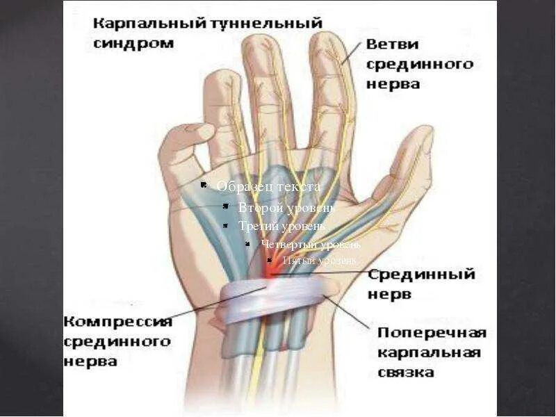 Невропатия локтевого нерва туннельный синдром. Сенсорная нейропатия локтевого нерва. Туннельная невропатия срединного нерва. Компрессионно-ишемическая нейропатия срединного нерва. Синдром карпального канала мкб 10