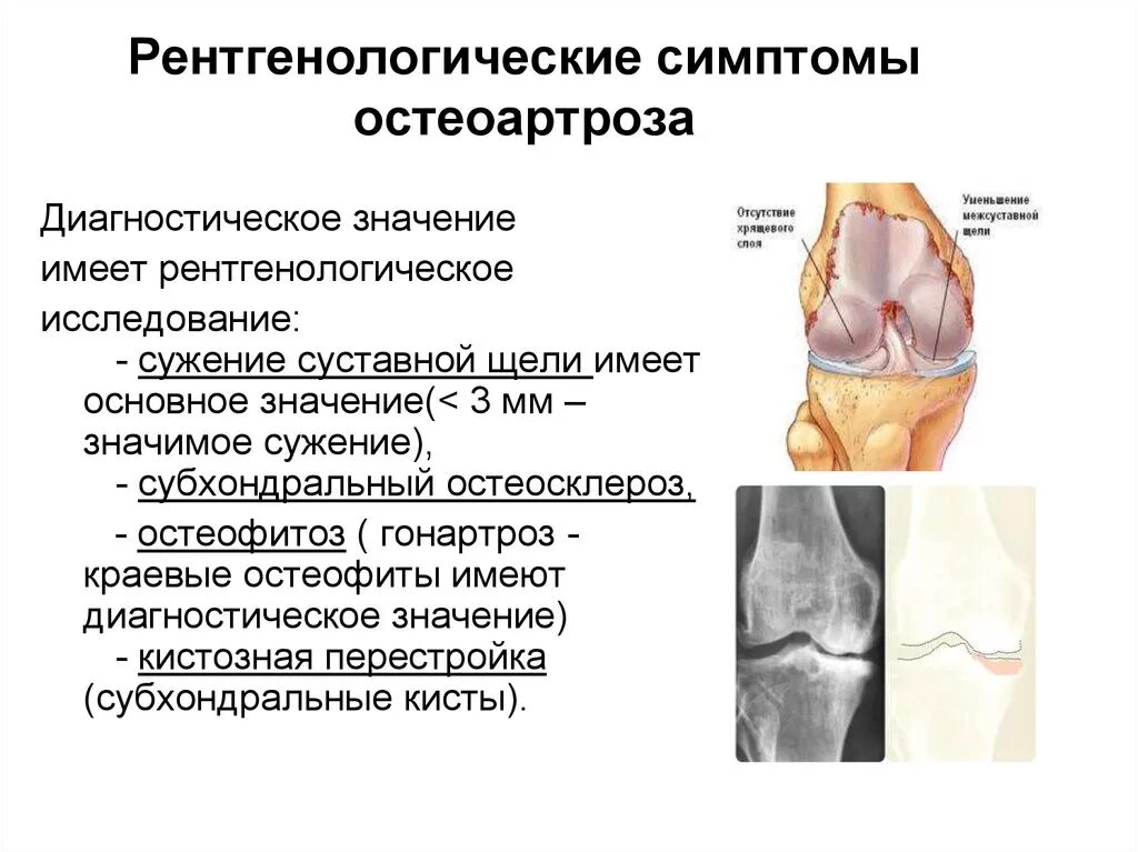 Рентгенологические стадии остеоартроза суставов. .Деформирующий остеоартрит остеоартроз. Характерные симптомы деформирующего остеоартроза. Остеоартроз коленного сустава стадии. Артроз коленного сустава название