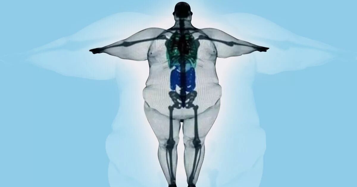 Скелет Толстого человека рентген. Широкая кость. Толстый человек рентген. Реген Толстого человека.