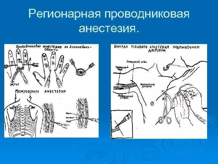 Обезболивающая блокада. Шейная блокада проводниковая анестезия. Проводниковая (регионарная) анестезия. Проводниковая анестезия при Пхо. Проводниковая анестезия локтевого нерва.